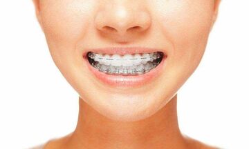 Orthodontic treatments Braces blackheath rowley regis