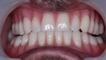 Dental Implants after photography Blackheath